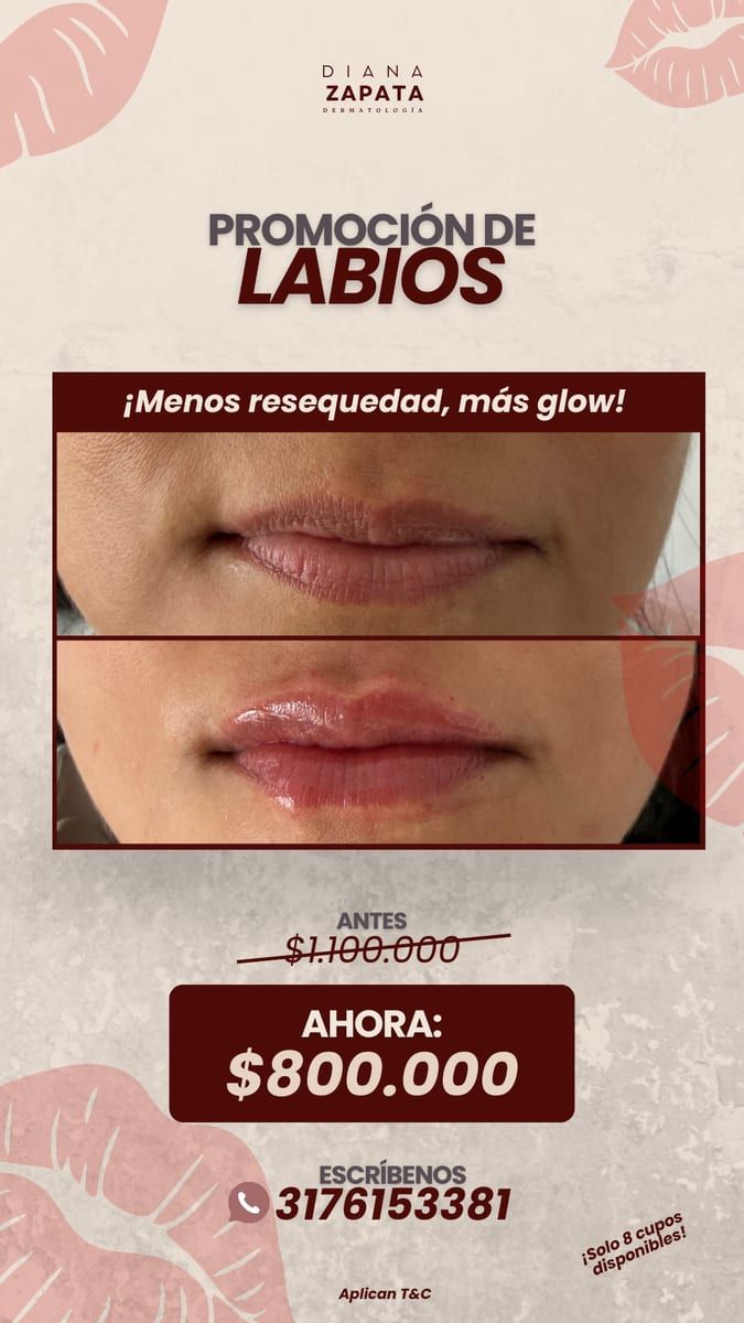 Banner de la promoción 💋 Promoción Especial – Relleno de Labios 💋